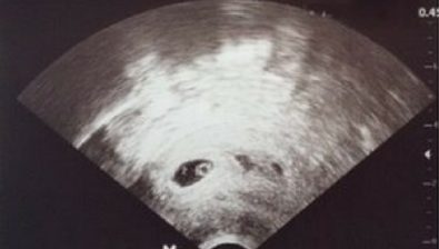 Ultrasonido de 6 semanas de embarazo # 2