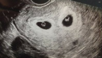 Ultrasonido de 6 semanas de embarazo # 3