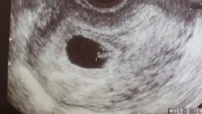 Ecografía de embarazo de 7 semanas # 1