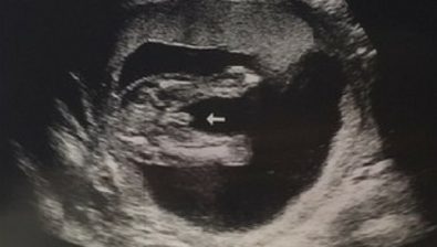 Ultrasonido de embarazo 17 semanas # 2