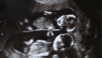 Ecografía de embarazo de 17 semanas # 4