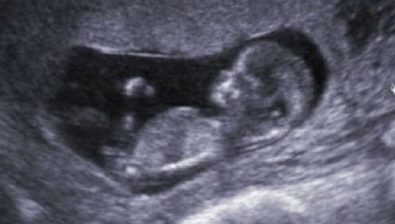Ultrasonido de embarazo 11 semanas # 2
