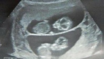 Ultrasonido de embarazo de 11 semanas # 4