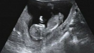 Ultrasonido de embarazo de 11 semanas # 3