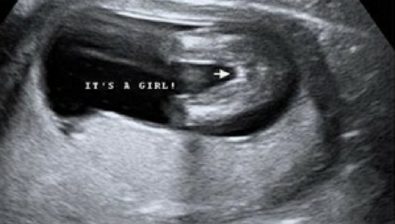 Ultrasonido de 34 semanas de embarazo # 2