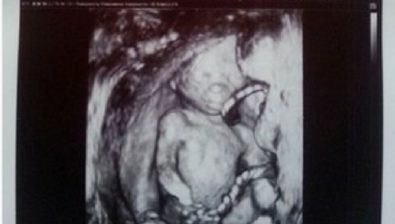 Ultrasonido de embarazo de 16 semanas # 3