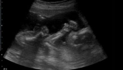 Ultrasonido de embarazo de 23 semanas # 2