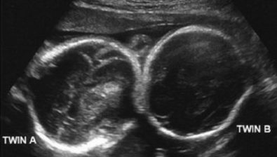 Ultrasonido de embarazo de 23 semanas # 4