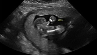 Ultrasonido de embarazo 31 semanas # 3