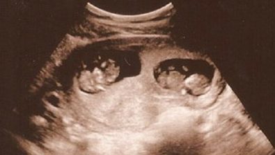 Ultrasonido de embarazo de 18 semanas # 4