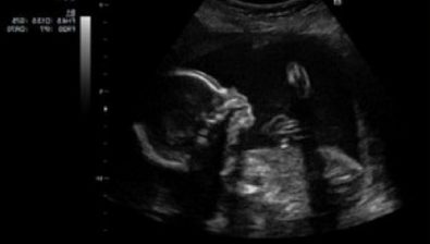 Ultrasonido de embarazo 21 semanas # 2