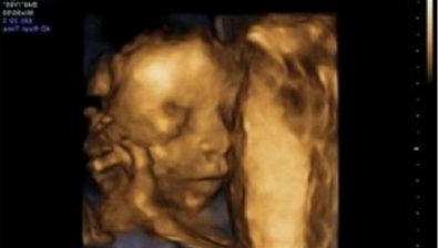 Ultrasonido de embarazo 21 semanas # 3