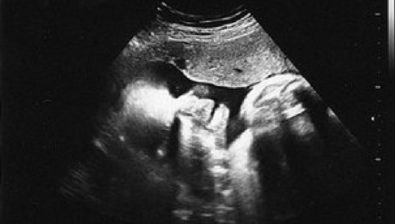 Ultrasonido de embarazo 35 semanas # 3