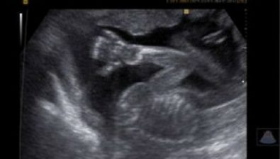 Ultrasonido # 2 de 19 semanas de embarazo