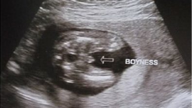 Ultrasonido de embarazo de 19 semanas # 3