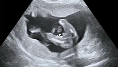 Ecografía de embarazo de 36 semanas # 3