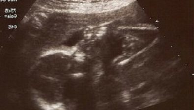 Ultrasonido de embarazo 22 semanas # 2