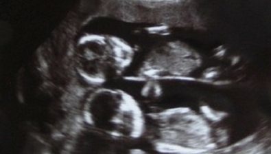 Ultrasonido de embarazo 22 semanas # 4