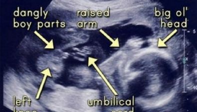 Ultrasonido de embarazo 22 semanas # 3