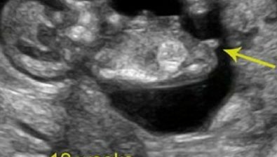 Ultrasonido # 2 de 12 semanas de embarazo