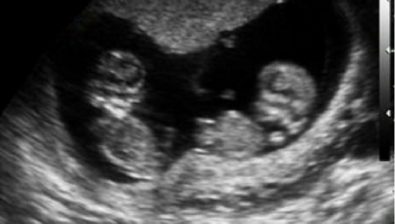 Ecografía de embarazo de 12 semanas # 4