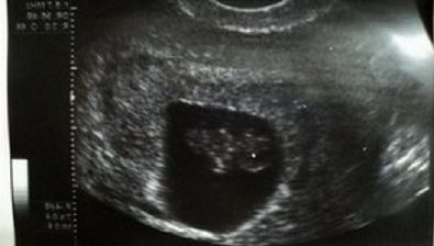 Ecografía de embarazo de 8 semanas # 4