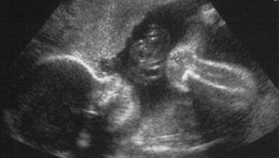 Ultrasonido de embarazo de 24 semanas # 2