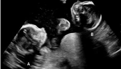 Ultrasonido de embarazo 24 semanas # 4