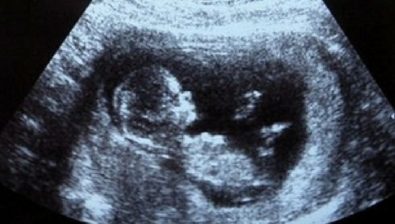 Ultrasonido de 11 semanas de embarazo # 1