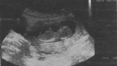 Ultrasonido # 1 de 13 semanas de embarazo