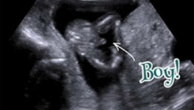 Ultrasonido # 1 de 15 semanas de embarazo