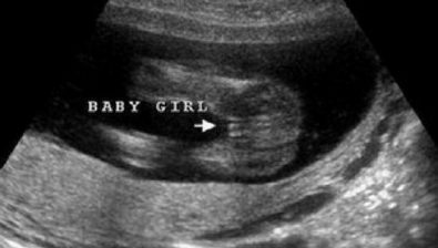 Ultrasonido # 1 de 16 semanas de embarazo