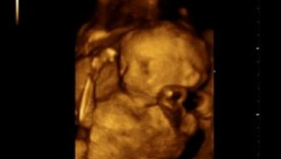 Ultrasonido de embarazo de 25 semanas # 1