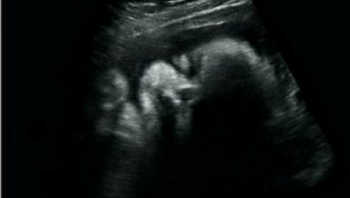 Ultrasonido de embarazo de 31 semanas # 1