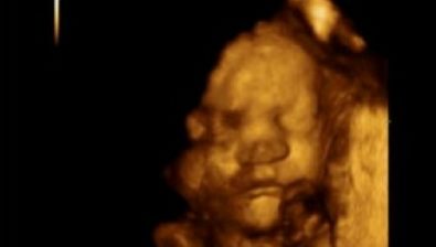 Ultrasonido no.  1 embarazada en 37 semanas